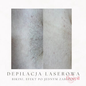 deepilstudio_depilacja_laserowa_6