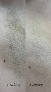 Depilacja laserowa pach