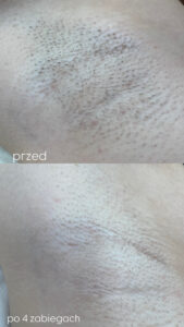 Depilacja laserowa pach po 4 zabiegach